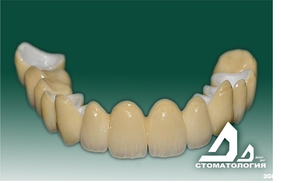 Дельта дент. Безметалловая коронка из диоксида.